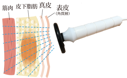 筋肉と表皮の間にある皮下脂肪の脂肪細胞にラジオ波を当てます。