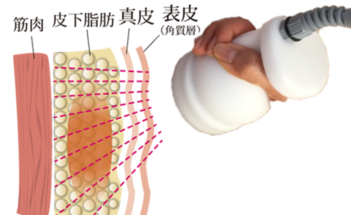 筋肉と表皮の間にある皮下脂肪の脂肪細胞にラジオ波を当てます。